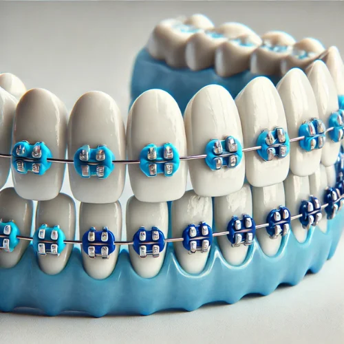 Blue Braces